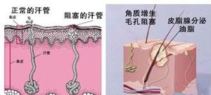 胸前长痘痘是什么原因?4大胸前长痘痘的原因