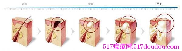 痤疮是主要发生起因之一:毛孔堵塞-健康吃瘦网