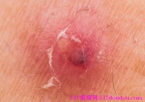 怎么从5个方面区分毛囊炎和痤疮?-517痘痘网