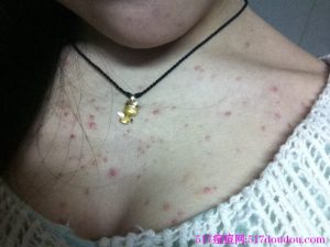 前胸后背长痘痘怎么办呢?-517痘痘网