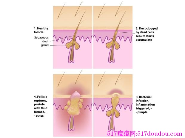 寻常性痤疮的产生原因是什么？