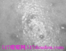 闭合性粉刺是什么?闭合性粉刺该如何护理?-健康吃瘦网
