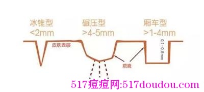痘坑分几种类型_去痘坑最有效的方法是哪种?-517痘痘网