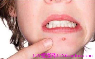 嘴巴周围长痘痘是什么原因？嘴巴周围长痘痘怎么办？
