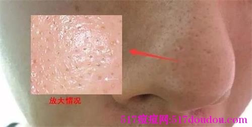 如何治痘痘？治痘痘最好的方法是什么？