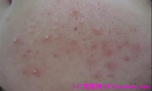 如何治痘痘？治痘痘最好的方法是什么？