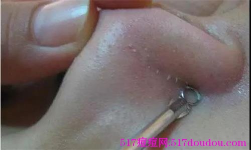 如何治痘痘？治痘痘最好的方法是什么？