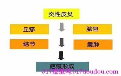 脸上有痘坑是怎么回事？痘坑有哪些分类？