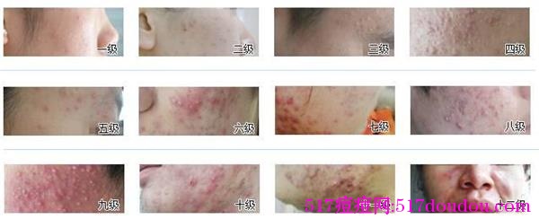 多种去痘疤痘坑靠谱吗？怎么消痘疤痘坑？