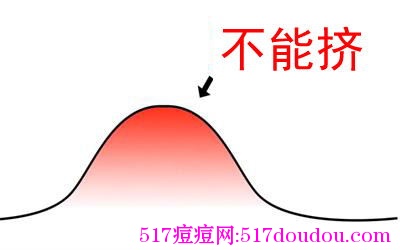 痘痘能挤吗？最正确方法是什么？