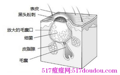 痘痘类型图解（祛痘必知！）