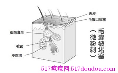 痘痘类型图解（祛痘必知！）