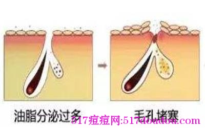 脸上长痤疮的原因有哪些？（很全面）