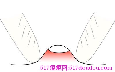 如何自己挤痘痘？