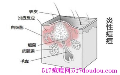 痘痘类型图解（祛痘必知！）