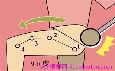 太阳穴长痘怎么办？