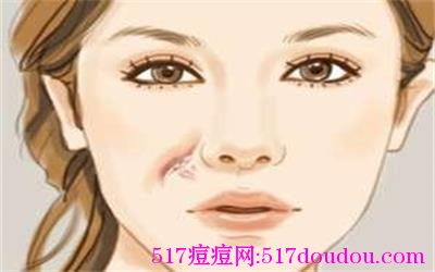 青春痘后遗症有哪些?-517痘痘网