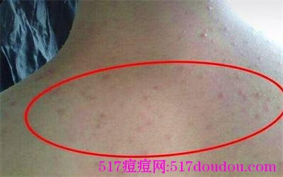如何消除背部痤疮?背部痤疮图片大全