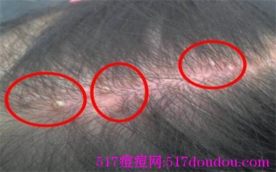 头上长痘痘是什么原因?头上长痘痘解决办法-健康吃瘦网