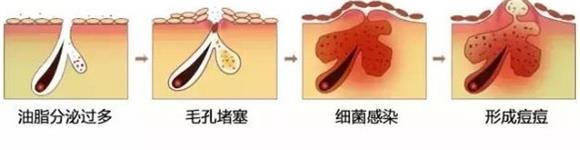 痘痘里面是什么?