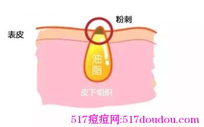 痘痘里面是什么?-517痘痘网