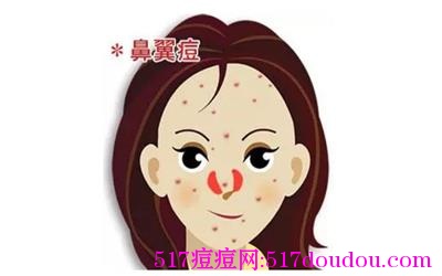 鼻翼两侧长痘怎么办？实用鼻翼两侧长痘解决办法