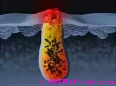 痤疮丙酸杆菌和痘痘有关吗？痤疮丙酸杆菌能导致痘痘吗？