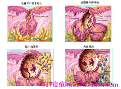 痤疮丙酸杆菌和痘痘有关吗？痤疮丙酸杆菌能导致痘痘吗？