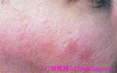 皮肤的分类有哪些？油性皮肤和敏感性皮肤护理技巧