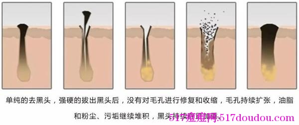 去黑头的最好方法！这样去黑头才有效