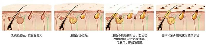 去黑头的最好方法！这样去黑头才有效