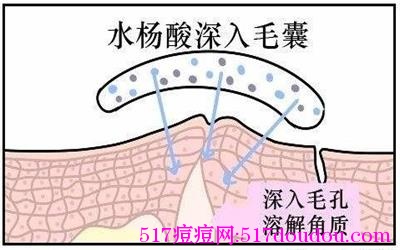 水杨酸可以祛痘吗？超分子水杨酸是什么？