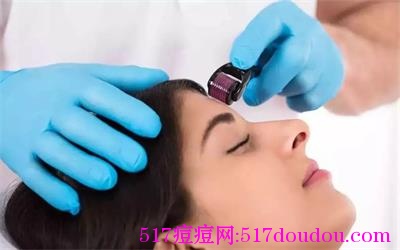 微针疗法能去痤疮和痤疮凹洞吗?-517痘痘网