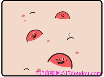 挤完痘痘后怎么处理才是正确的？