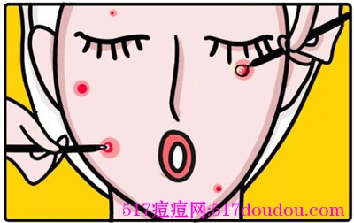 挤完痘痘后怎么处理才是正确的？