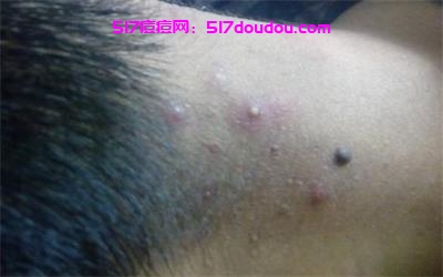 脖子上长痘痘是什么原因？脖子上长痘痘解决办法