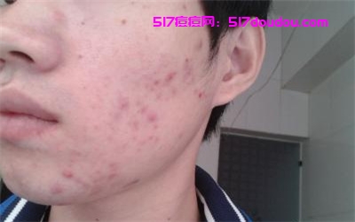痘痘是什么引起的？