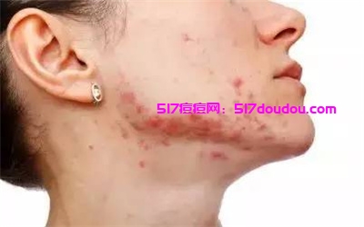 专业去痘印好方法有哪些?